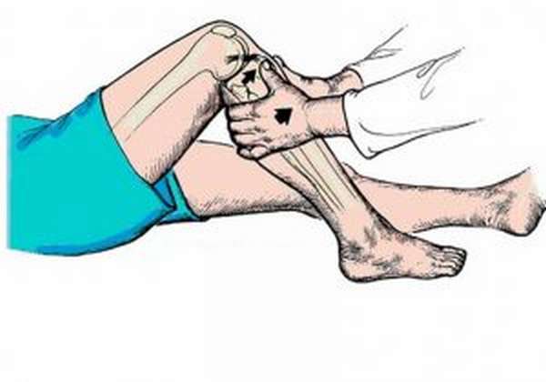Разрыв крестообразной связки сустава колена